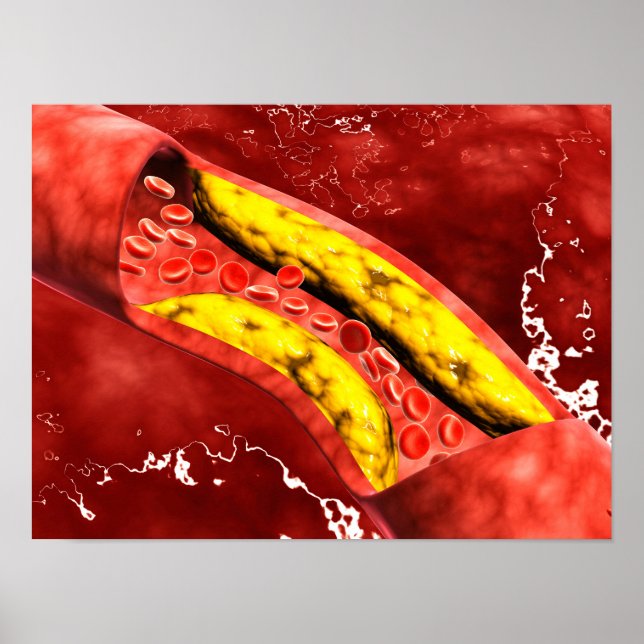 Microscopic View Of Fat Plaque Inside The Artery Poster (Front)