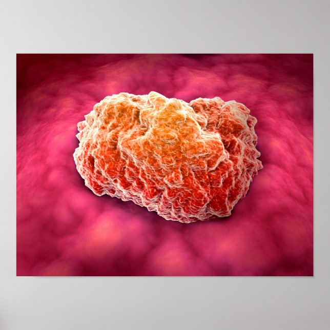 Microscopic View Of Tumour 3 Poster (Front)