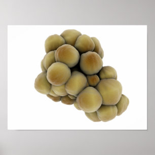 Microscopic View Of Tumour 5 Poster