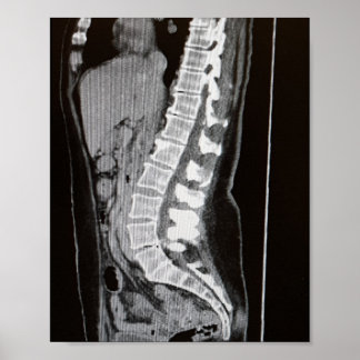 MRI of the Spine Poster
