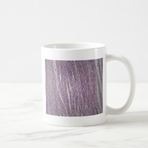 Mug Cellules de tissu humain d'utérus avec le tumo