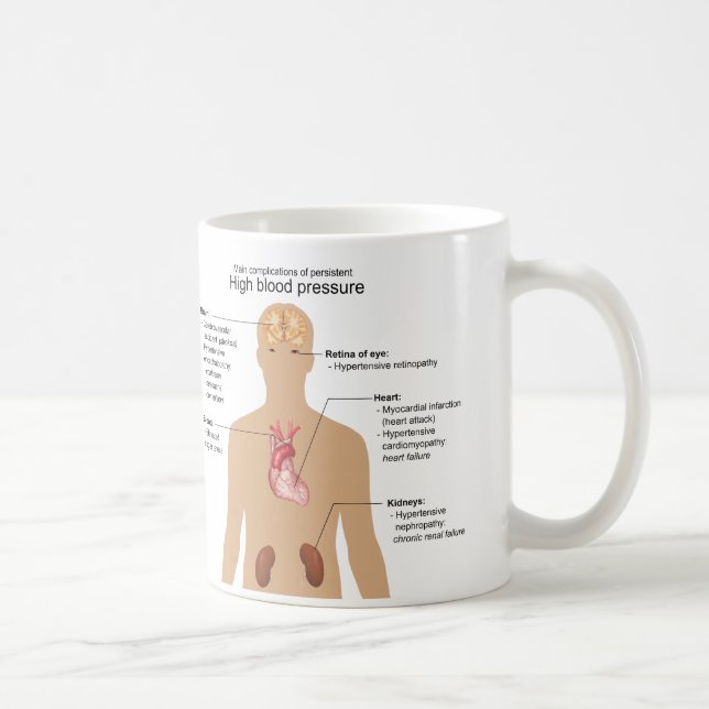 Mug Complications principales de diagramme (Droite)