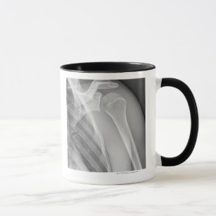 Mug Épaule normale. Rayon X de la gauche saine
