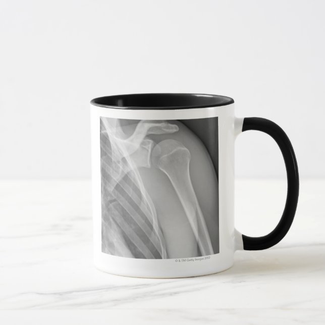 Mug Épaule normale. Rayon X de la gauche saine (Droite)