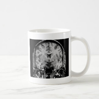 Mug IRM cérébral, tranche coronale