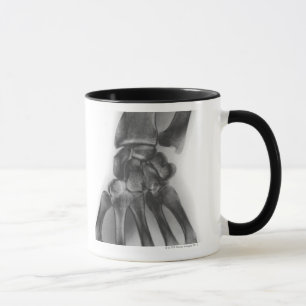 Mug Poignet normal, rayon X