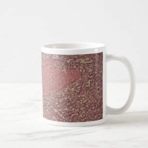 Mug Rate humaine avec la leucose myélogène chronique