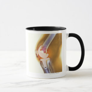 Mug Remplacement de genou. Rayon X coloré d'un genou