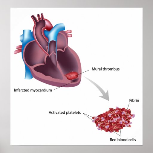 Mural thrombus after heart attack Poster | Zazzle