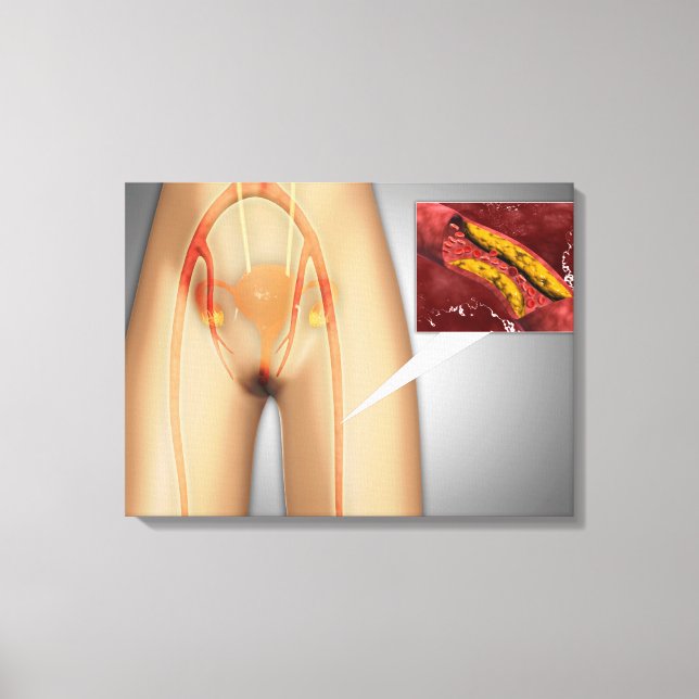 Narrowed Artery Near Leg Close-up Canvas Print (Front)