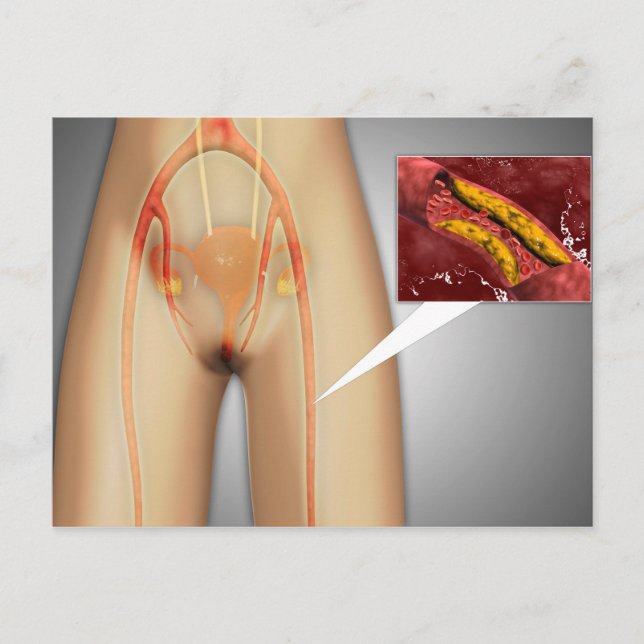 Narrowed Artery Near Leg Close-up Postcard (Front)