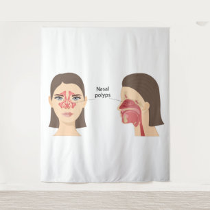 Nasal polyps tapestry