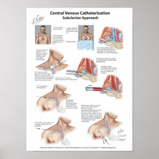 Netter Chart: Central Venous Catheterization Poster