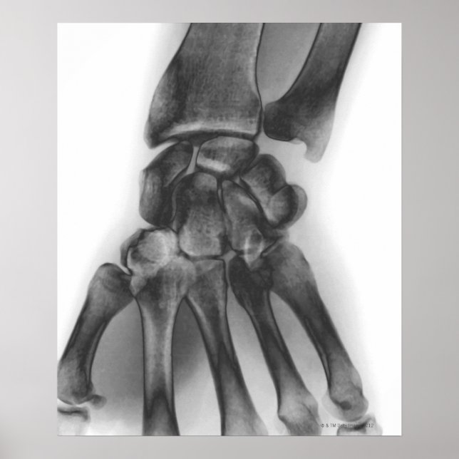 Normal wrist, X-ray Poster (Front)