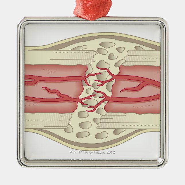 Ornement Carré Argenté Os se réparant 2 (Devant)