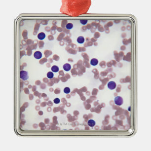 Ornement En Métal Cellules néo-plastiques de lymphocyte