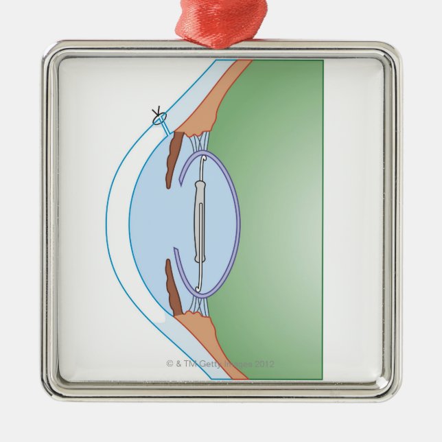 Ornement Métallique Chirurgie de cataracte (Devant)