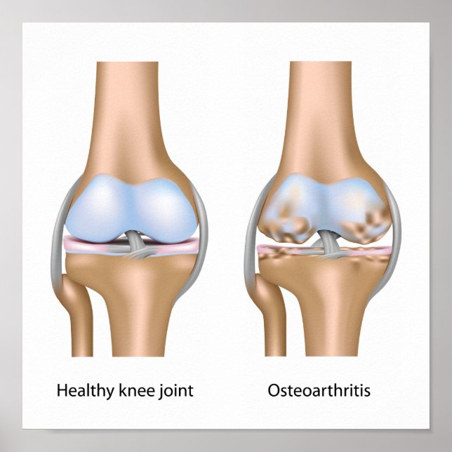 Ostéoarthrite de l'articulation du genou Poster (Devant)