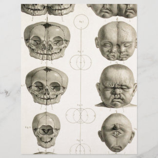 Papier Déformations crâniennes du nourrisson Bébé bizarre