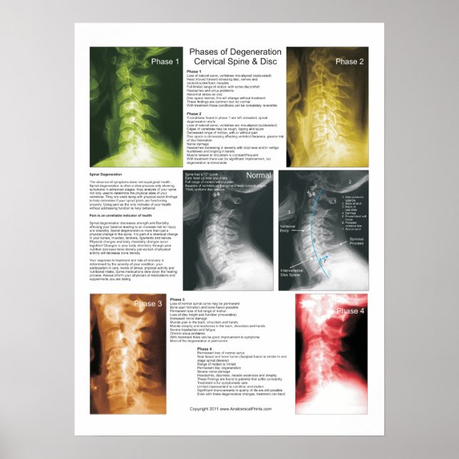 Phases Cervical Spinal Degeneration Poster (Front)
