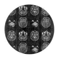 Analyse IRM du cerveau