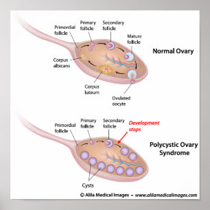 Polycystic ovary syndrome, labelled diagram. poster