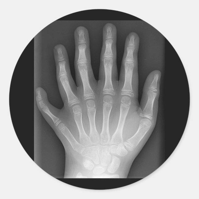 Polydactyly, Six Fingered Hand, X-Ray, rarity! Classic Round Sticker (Front)