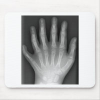 Polydactyly, Six Fingered Hand, X-Ray, rarity!