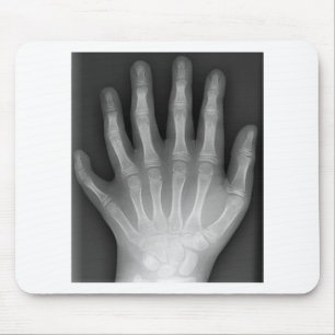 Polydactyly, Six Fingered Hand, X-Ray, rarity! Mouse Pad