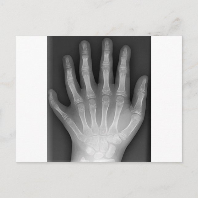Polydactyly, Six Fingered Hand, X-Ray, rarity! Postcard (Front)