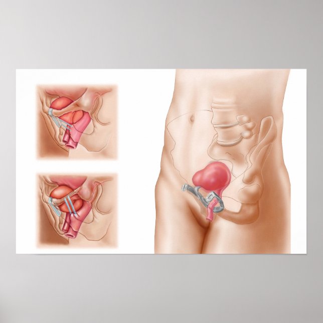 Poster Anatomie De La Procédure De Suspension De Vessie (Devant)