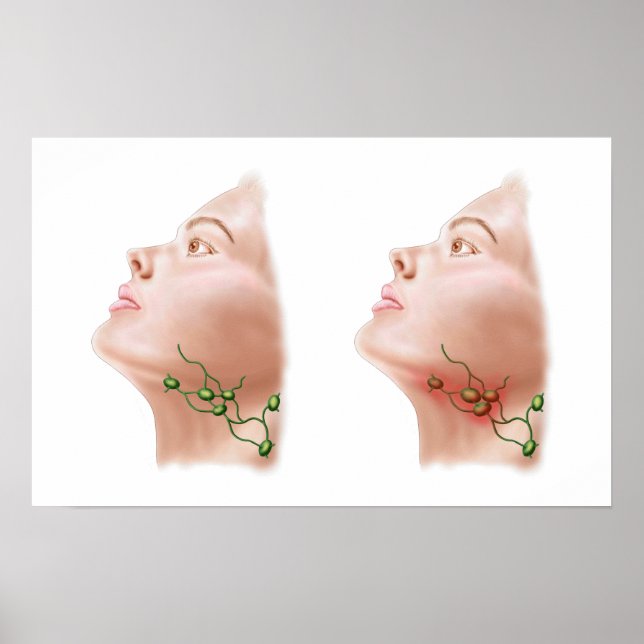 Poster Anatomie Des Noeuds Lymphe Gonflés (Devant)