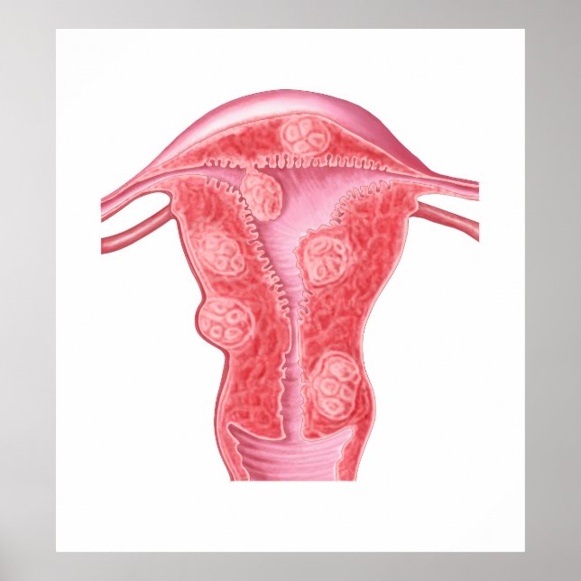 Poster Anatomie Des Tumeurs Fibroïdes Dans L'Utérus Fémin (Devant)