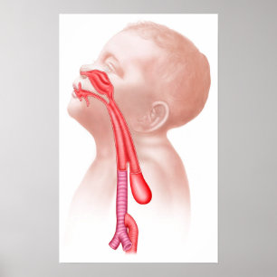 Poster Anatomie D'Une Fistule Trachéesophagienne