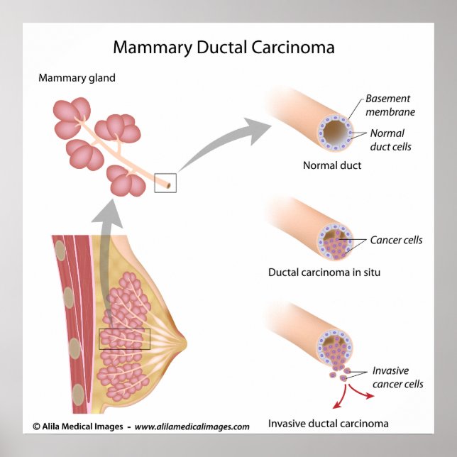 Poster Cancer du sein : carcinome ductal, schéma labellis (Devant)