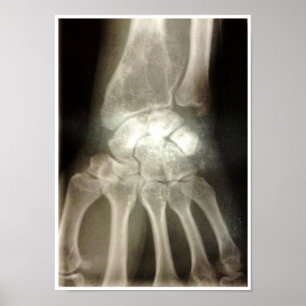Poster Carpals Xray