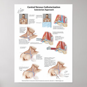 Poster Carte réseau : Cathétérisation veineuse centrale