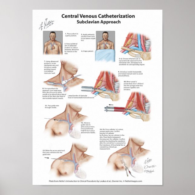 Poster Carte réseau : Cathétérisation veineuse centrale (Devant)