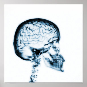 POSTER CERVEAU JUMEAU X-RAY - BLEU