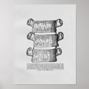 Poster Chiropractic Vertebral Subluxation Vintage Print