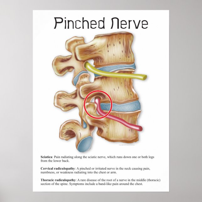 Poster Chiropratique de la thérapie physique du nerf broc (Devant)