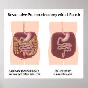 Poster Chirurgie proctocolectomique réparatrice avec j-po