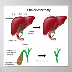 Poster Cholecystectomie vésicule biliaire enlèvement chir