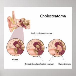 Poster Cholesteatoma tumeur de l'oreille moyenne