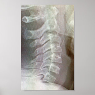 Poster Cravate cervicale d'épine