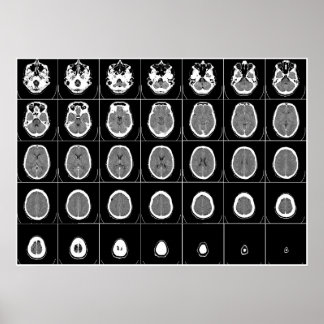 POSTER CT SCAN DE TÊTE