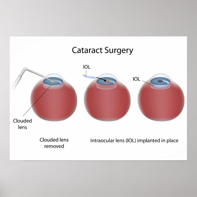Poster de chirurgie cataracte (Devant)