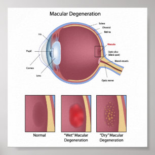 Poster de dégénérescence maculaire des yeux