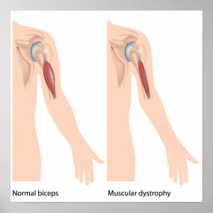 Poster de la dystrophie musculaire