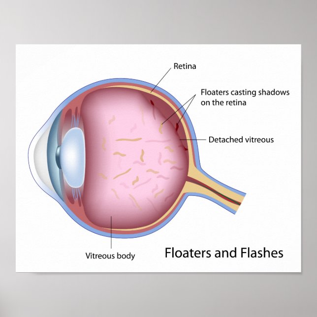 Poster de la maladie oculaire des flotteurs et des (Devant)